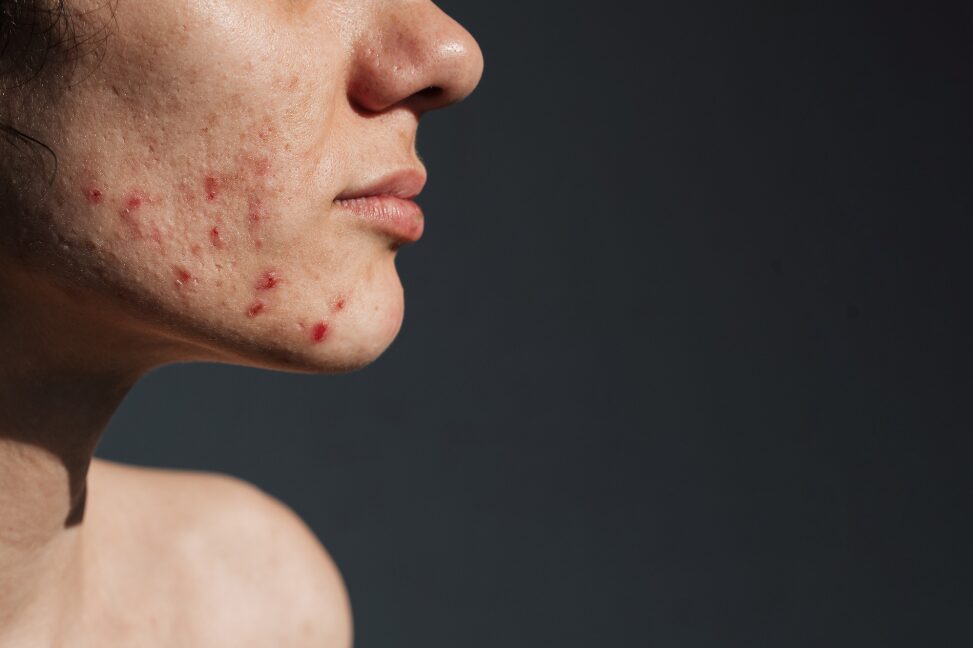 Hormonelle Akne: Symptome, Diagnose, Behandlung