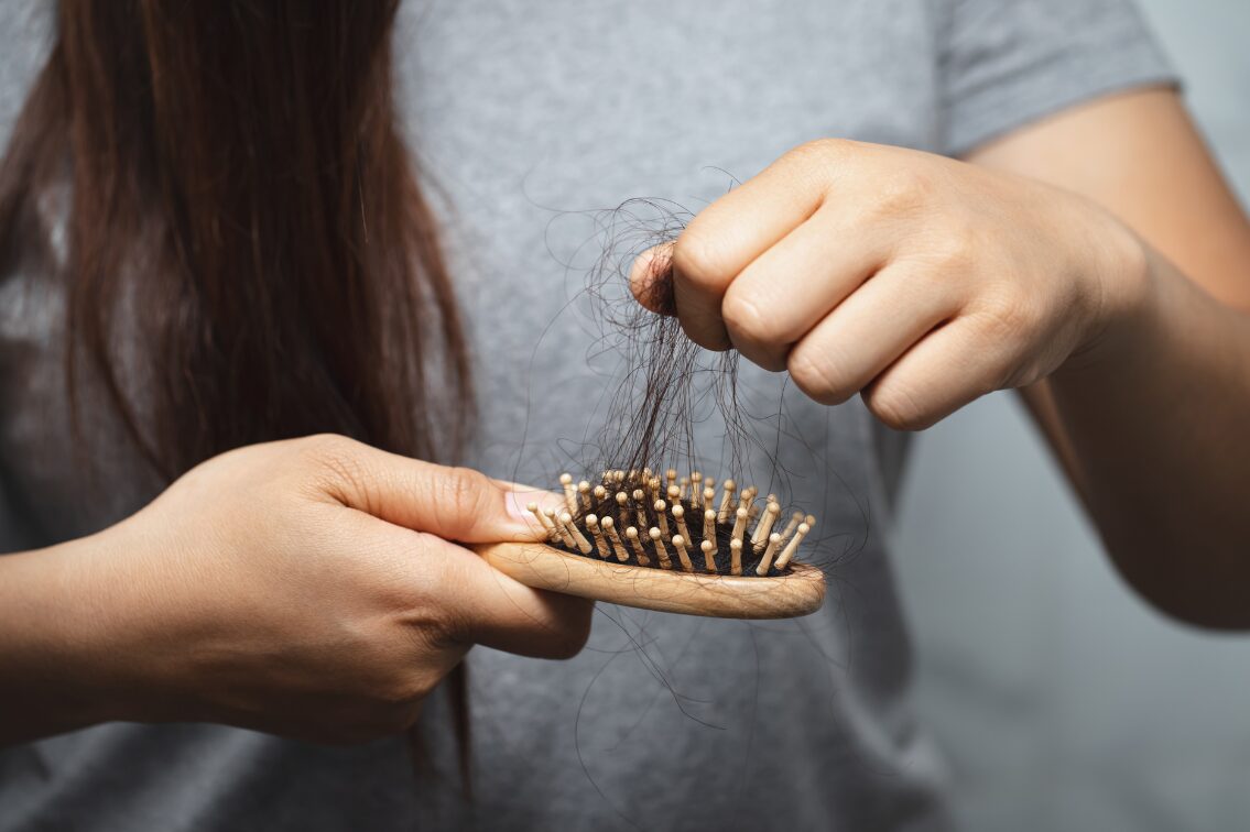 Haarausfall, viele Haare werden aus einer Bürste gezogen